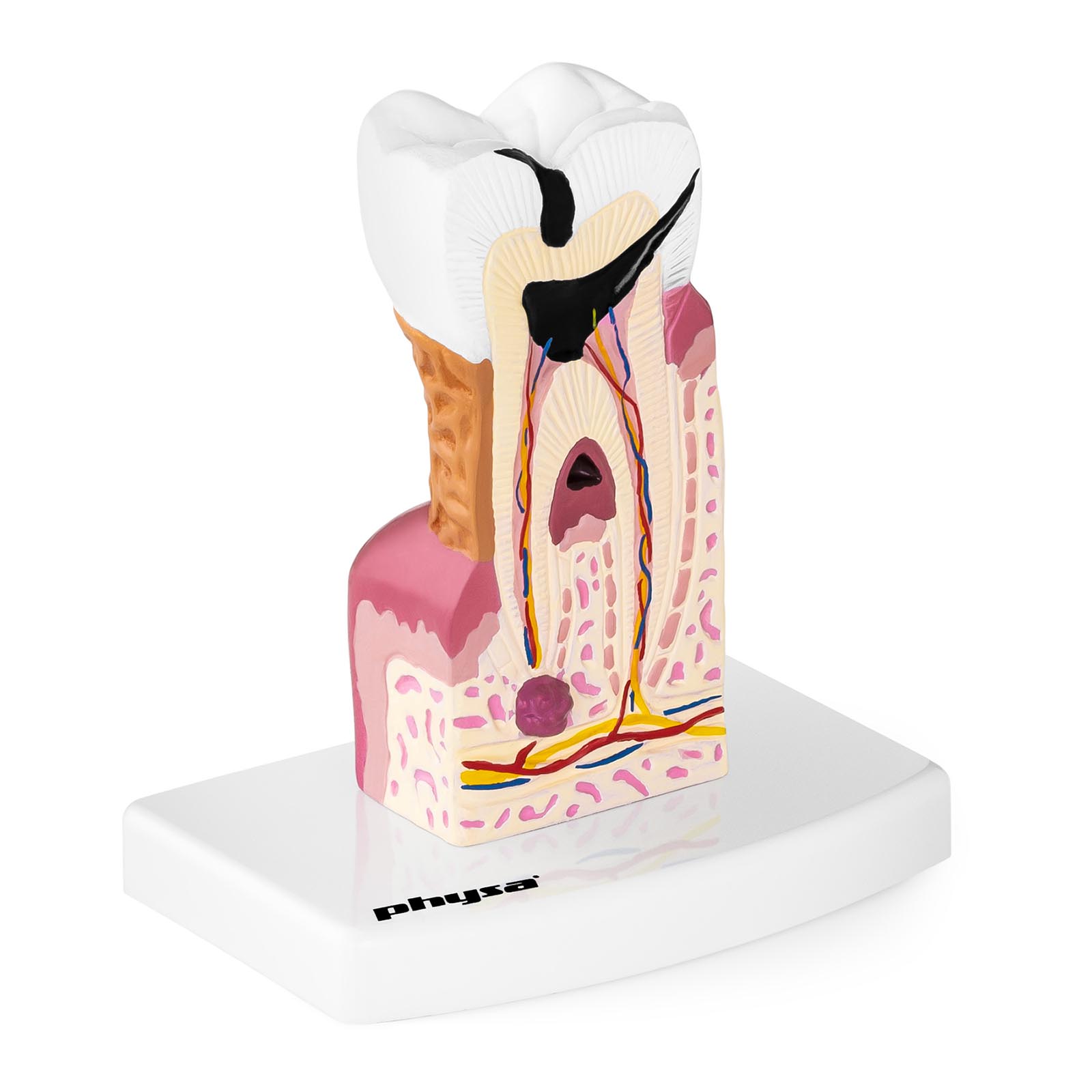 Modelo de diente - molar enfermo